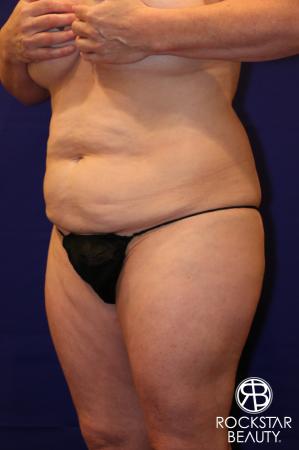 Tummy Tuck: Patient 12 - Before Image 2