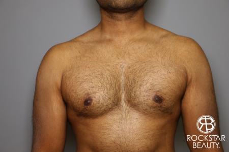Liposuction: Patient 16 - After Image 3