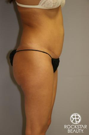 Liposuction: Patient 3 - Before Image 3