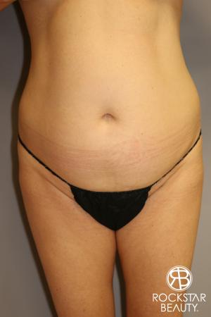 Tummy Tuck: Patient 1 - Before Image 1