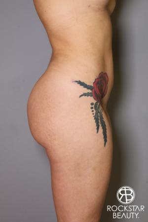 Brazilian Butt Lift: Patient 18 - After Image 3