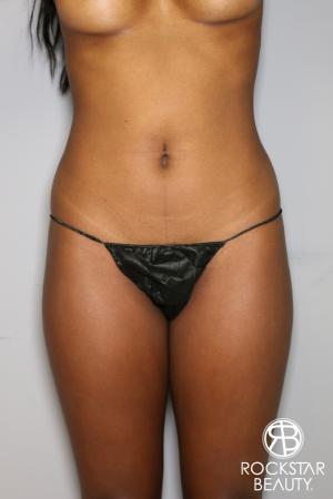 Liposuction: Patient 19 - Before Image 3