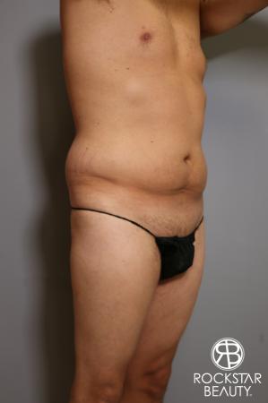 Tummy Tuck: Patient 5 - Before Image 3
