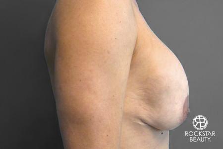Breast Implant Exchange: Patient 2 - Before 2
