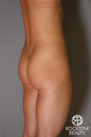 Butt Augmentation: Patient 3 - Before Image 4