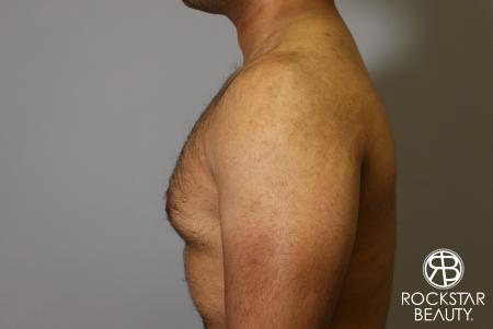 Liposuction: Patient 16 - Before Image 1