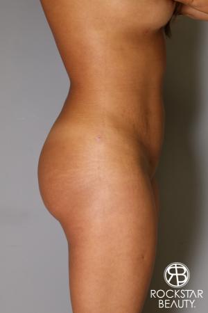 Brazilian Butt Lift: Patient 9 - After Image 2