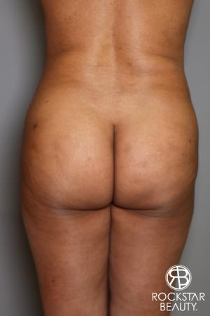 Brazilian Butt Lift: Patient 11 - Before Image 1