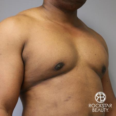 Gynecomastia: Patient 1 - After 2