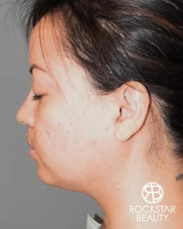 SmartLipo®-Face/Neck: Patient 1 - Before Image 1