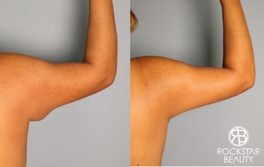 Liposuction: Patient 26 - Before and After 1