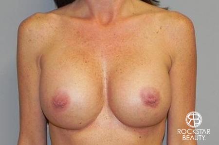 Breast Augmentation: Patient 5 - After 1