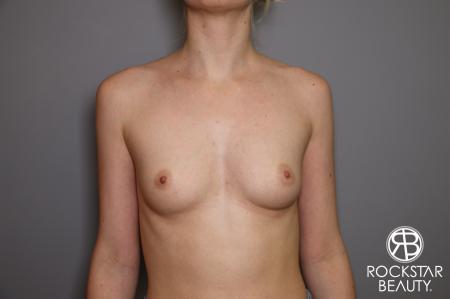 Breast Augmentation: Patient 2 - Before Image 1