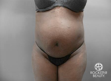Tummy Tuck: Patient 7 - Before 1