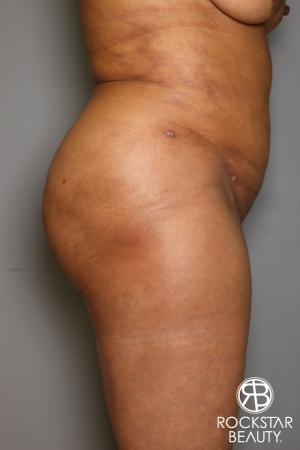 Brazilian Butt Lift: Patient 11 - After Image 4