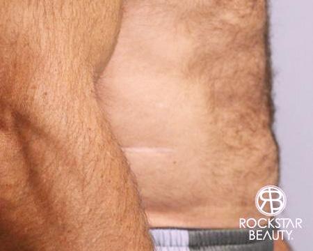 SmartLipo®: Patient 2 - After Image 3