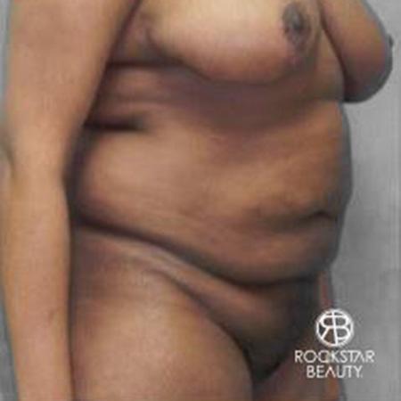 Tummy Tuck: Patient 9 - Before 2