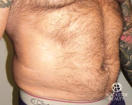SmartLipo®: Patient 2 - Before Image 2