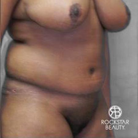 Tummy Tuck: Patient 9 - After 2