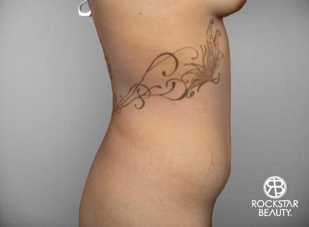 SmartLipo®: Patient 3 - Before Image 2