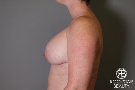 Breast Augmentation: Patient 11 - After Image 5