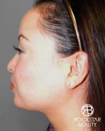 SmartLipo®-Face/Neck: Patient 1 - After Image 1