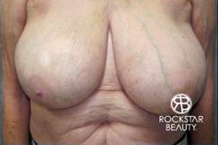 Breast Reduction: Patient 2 - Before 