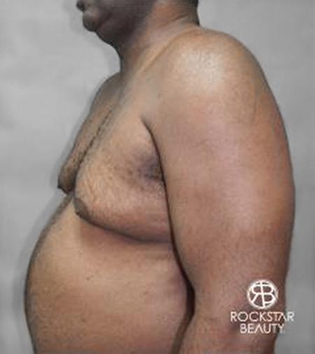 Gynecomastia: Patient 2 - Before and After 2