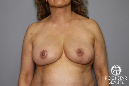 Mastopexy: Patient 3 - After Image 1
