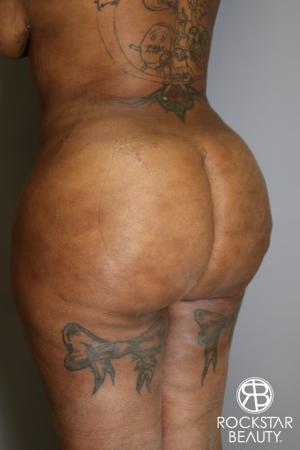 Brazilian Butt Lift: Patient 15 - After Image 3