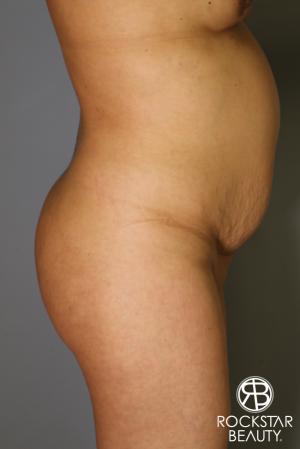 Brazilian Butt Lift: Patient 12 - Before Image 3