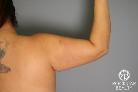 Liposuction: Patient 12 - Before and After Image 4