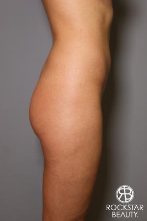 Brazilian Butt Lift: Patient 5 - Before Image 3