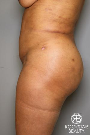 Brazilian Butt Lift: Patient 11 - After Image 5