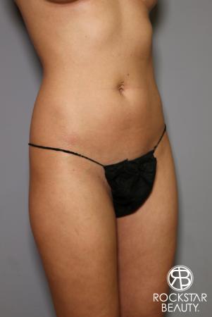 Brazilian Butt Lift: Patient 5 - Before and After Image 5