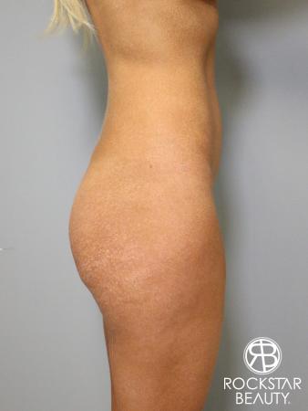 Butt Augmentation: Patient 1 - Before and After Image 3