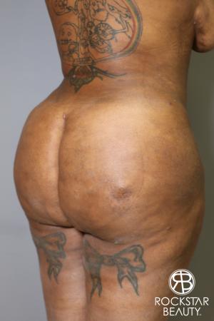 Brazilian Butt Lift: Patient 15 - After Image 2