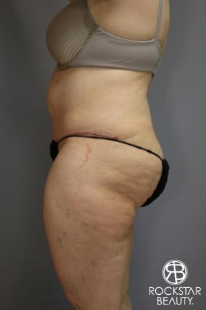 Tummy Tuck: Patient 4 - After Image 5