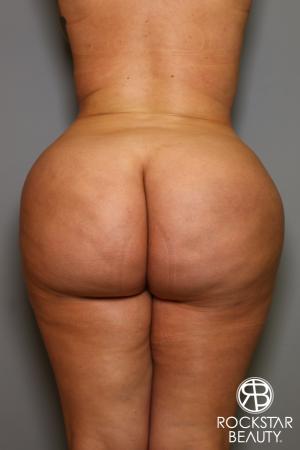 Brazilian Butt Lift: Patient 14 - After Image 1