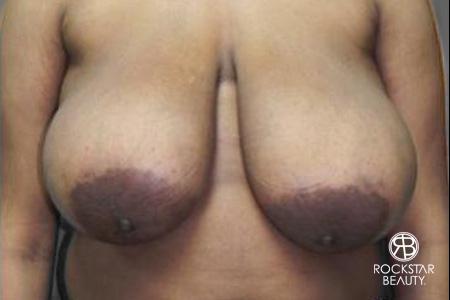 Breast Reduction: Patient 1 - Before 1