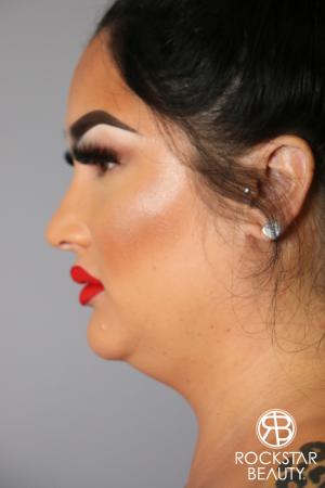 SmartLipo®-Face/Neck: Patient 2 - Before Image 1