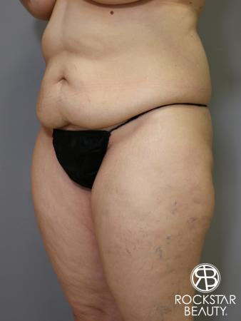 Tummy Tuck: Patient 4 - Before Image 4