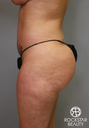 Liposuction: Patient 7 - Before and After Image 5