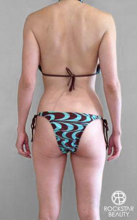Liposuction: Patient 8 - After 3
