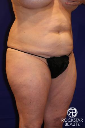Tummy Tuck: Patient 12 - Before Image 3
