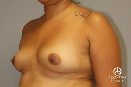 Breast Augmentation: Patient 9 - Before 3