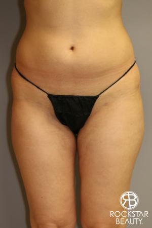 SmartLipo®: Patient 1 - After Image 1