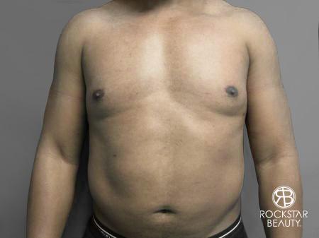 Liposuction: Patient 10 - After Image 1
