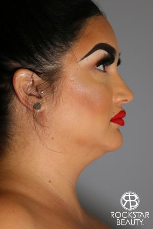 SmartLipo®-Face/Neck: Patient 2 - Before and After Image 2