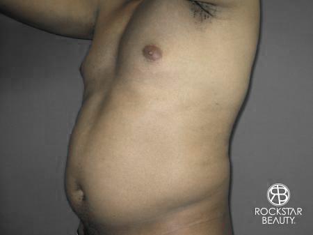 Liposuction: Patient 10 - Before 4